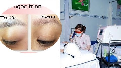 Xóa xăm lông mày có bị rụng lông không ? ngoc trinh spa