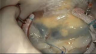Mini Mitral Valve Repair SM   SD 480p