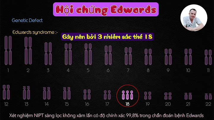 Hội chứng edward trisomy 18 bao nhiêu là nguy hiểm năm 2024