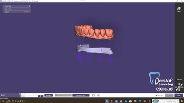 تصميم ibar باستخدام ال Exocad partial