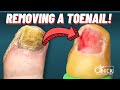 Fungal Toenail Removal by Dr. Nick Campitelli: A Pain-Free Solution to Healthy Feet!
