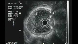 REFLECTION (MIRROR IMAGE ARTIFACT) DURING EUS CHRISTOS KARALIS MD.