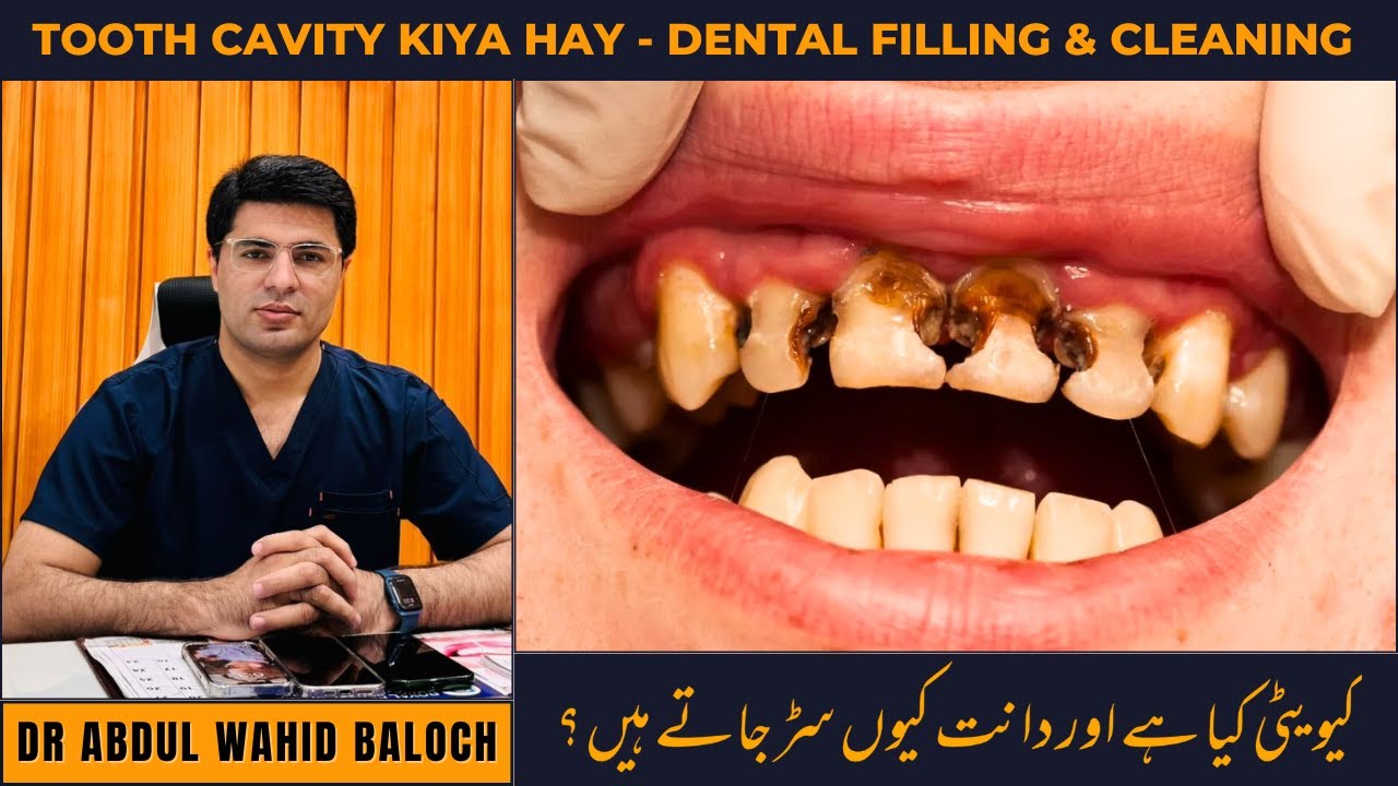 Tooth Cavity Urdu Hindi - Dant Dard Ka Ilaj - Dental Filling & Cleaning