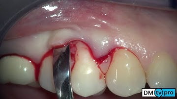 Single gingival recession: treatment with Mucograft matrix