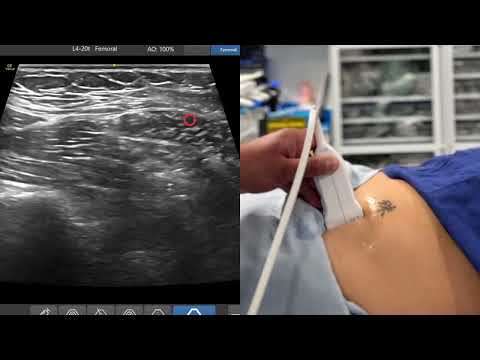 Image of New Scanning Tutorial for Suprainguinal Fascia Iliaca Block