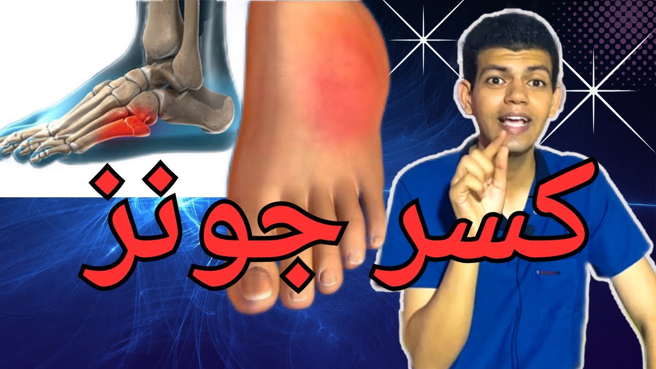كسر جونز /مشط القدم الخامس/العلاج