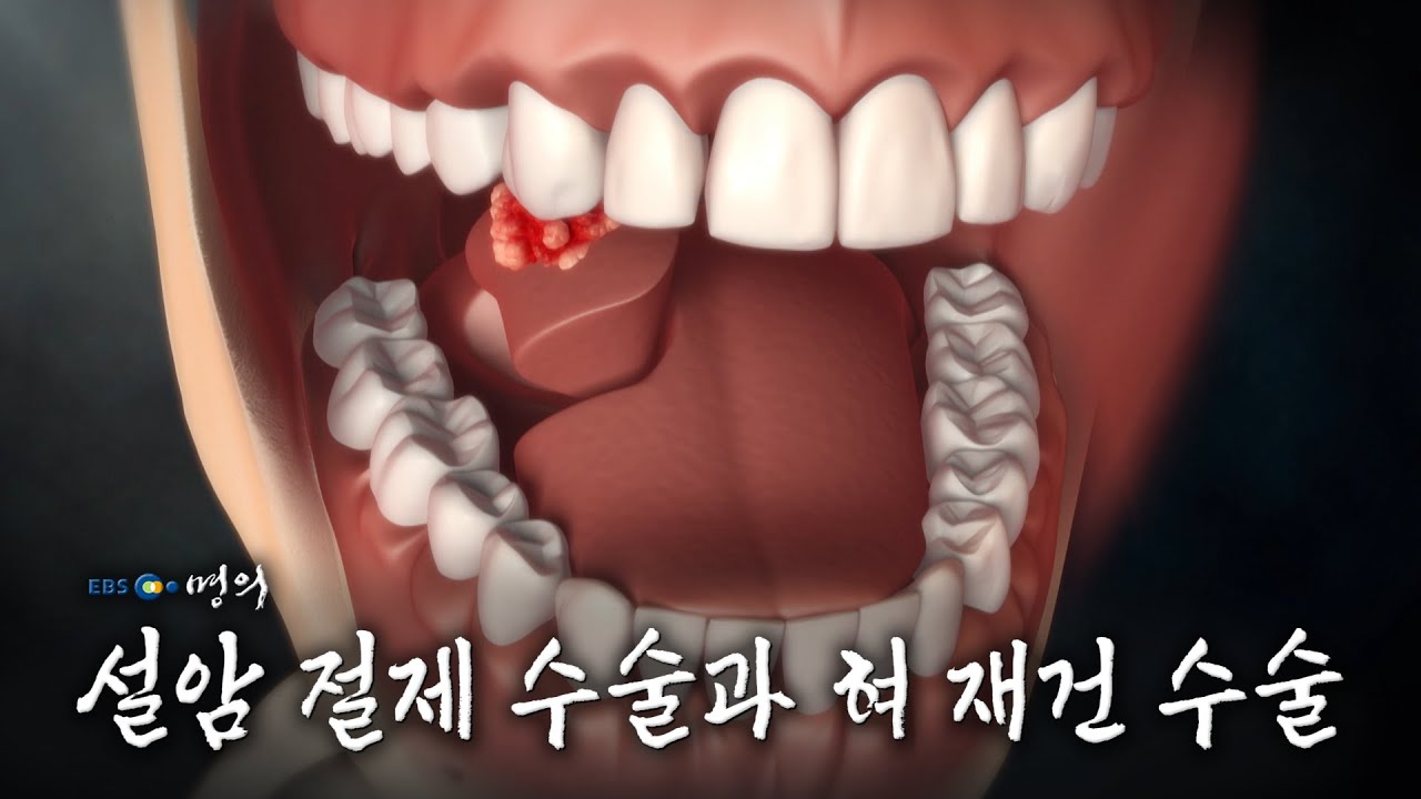 [명의 의학백과📖] 설암 절제 수술과 혀 재건 수술 - YouTube