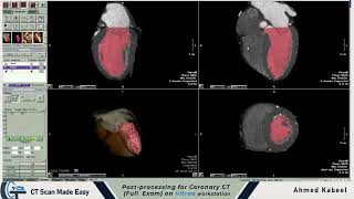 Famous Post-Processing For Coronary CT Full  Exam On Vitrea Wealth