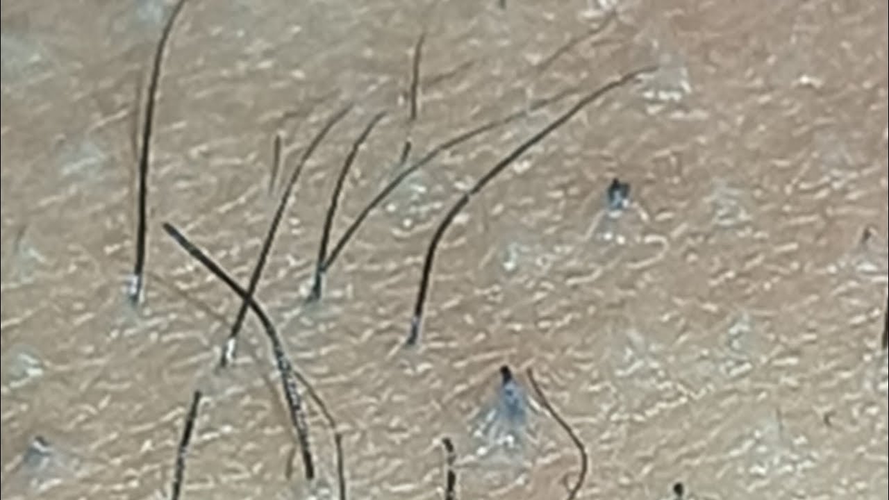 **JUICY** SATISFYING INGROWN HAIR REMOVAL😍😍😍 YouTube