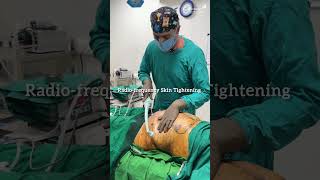 Radiofrequency Skin Tightening for Body Contouring | Advanced Body Sculpting