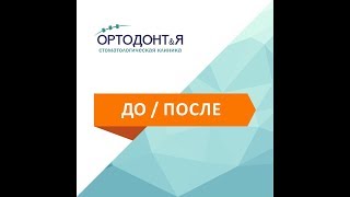 Коронка из диоксида циркония Краснодар Коронка из диоксида циркония Краснодар