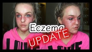 My Eczema Story: UPDATE 2017