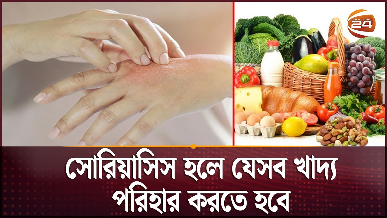 সোরিয়াসিস হলে যেসব খাদ্য পরিহার করতে হবে | Psoriasis | Skin care | Health Care | Channel 24