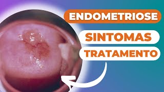 ENDOMETRIOSE sintomas e tratamento.