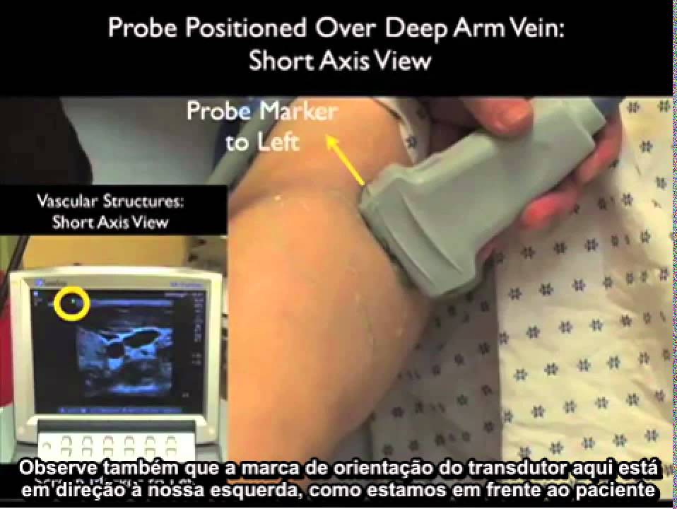 Acesso Vascular -EDU00231 Acesso Venoso Periférico com Ultrassom Portátil SonoSite