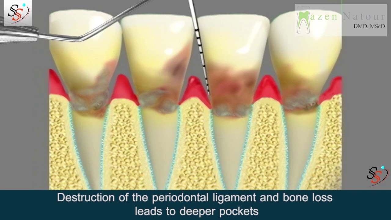 Periodontal Scaling and Root Planing (SRP) - Mazen Natour, DMD