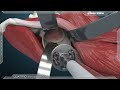 Prothse totale de hanche pth  chirurgie arthrose voie antrieure miniinvasive  dr tournemine