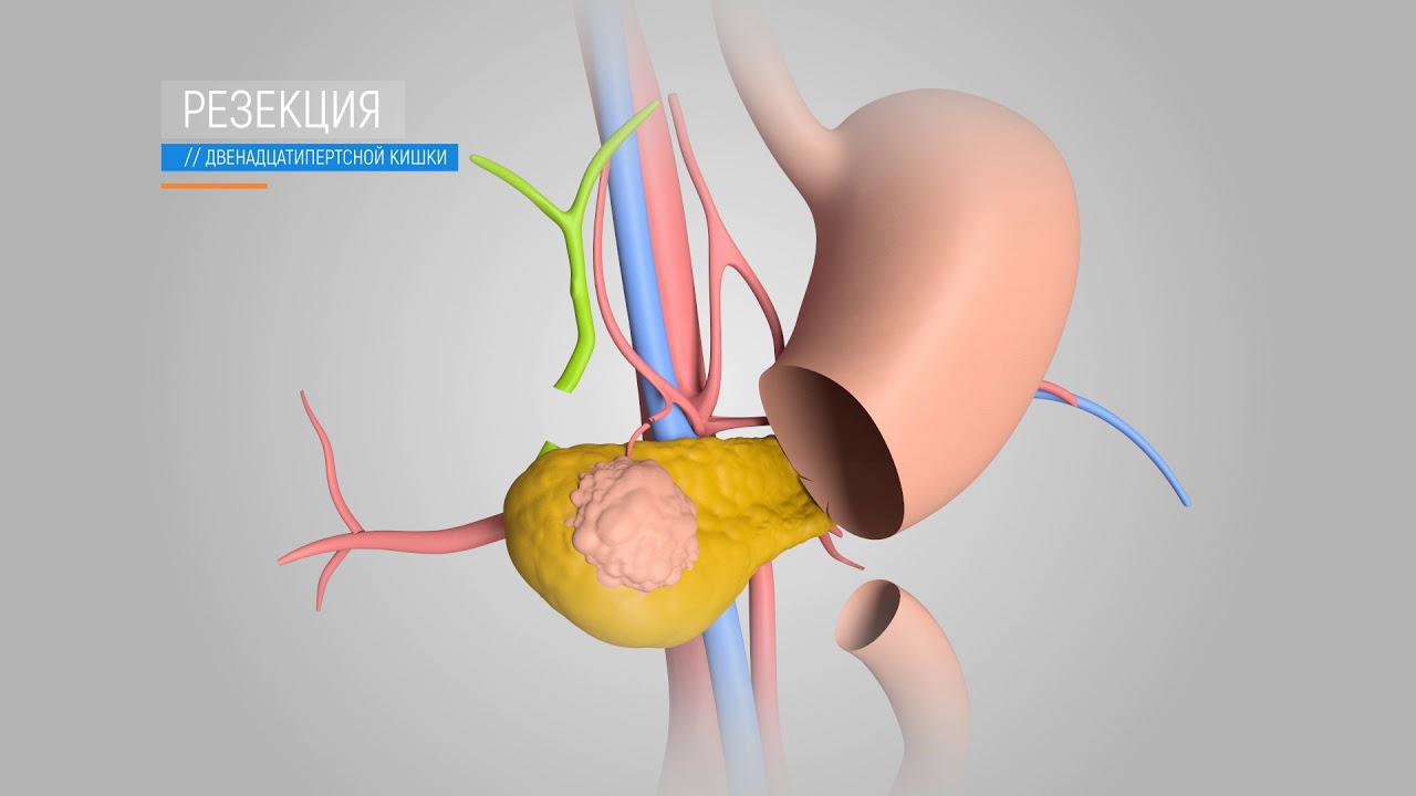 Расширенная панкреато-дуоденальная резекция (операция по Уиплу)