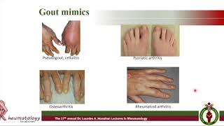 Holistic Care for Patients with Gout_17th LMLR