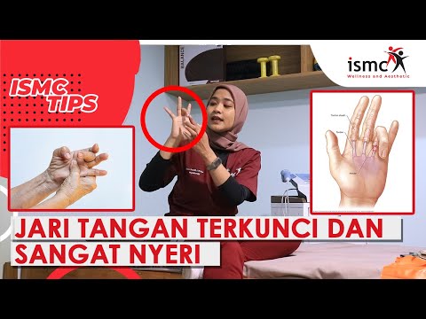 Video: Cara Mengobati Trigger Finger: 8 Langkah (dengan Gambar)