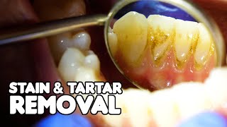 Dental Cleaning EXPLAINED | Stain & Tartar Removal
