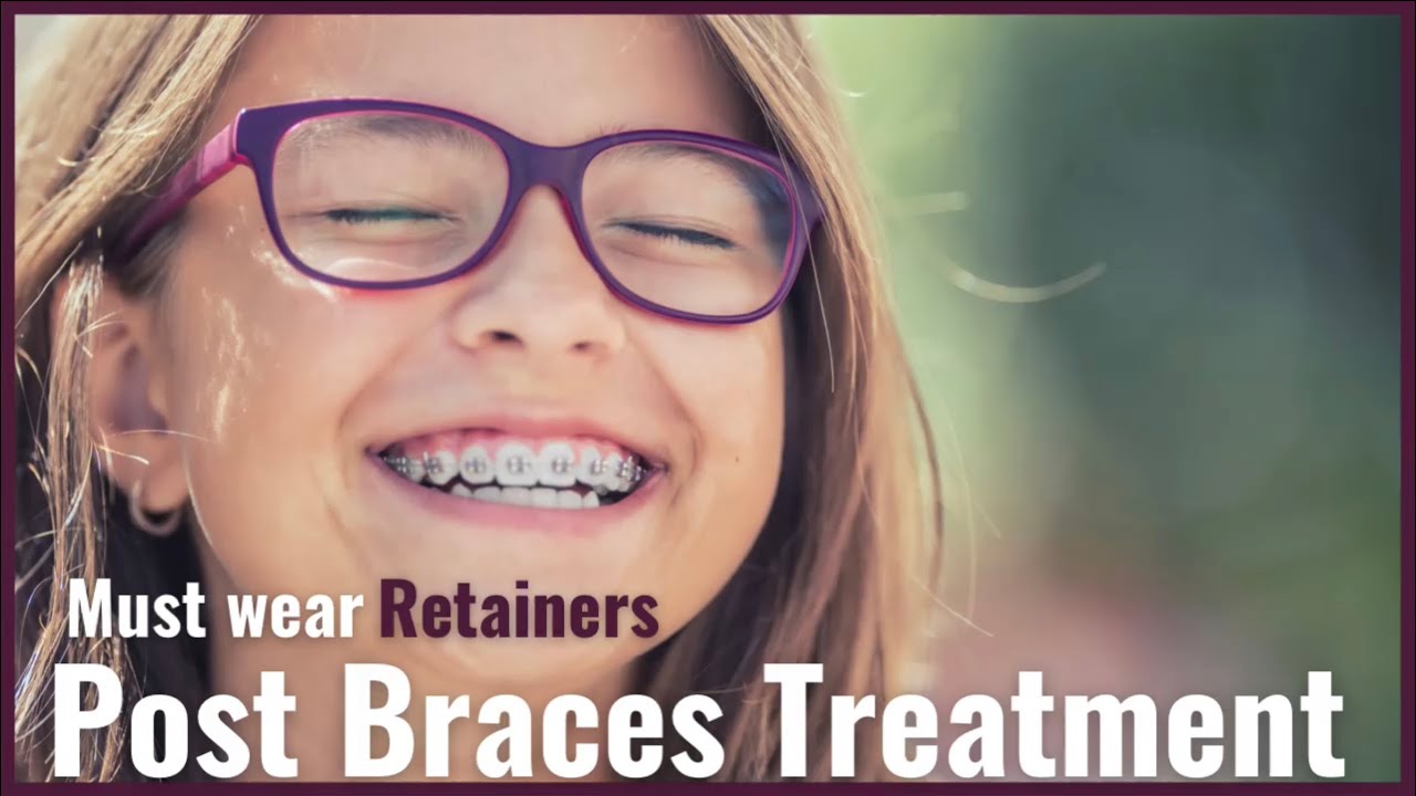 What are Retainers types of Retainers which is best Retainer given