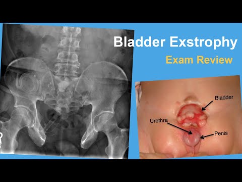 Bladder Exstrophy Exam Review - Rachel Goldstein, MD
