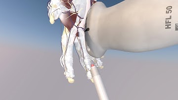 3D Model of a Ultrasound Guided Trigger Finger Injection by probeultrasound.com
