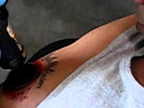 crazy Redneck Tattoo removal