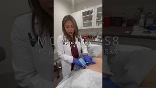 Stretch Mark removal treatment: Morpheus8 Radiofrequency Microneedling! #stretchmarksremoval