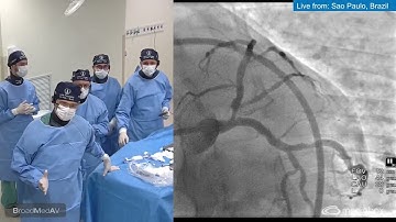 FFR and IVUS-Guided Single Stent PCI from LM to Ostial LAD