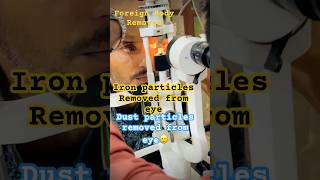 Foreign Body removed in eyes | Dust removed in eye | Iron particles removed |Eye clean|#eye #ytshort