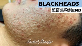 超密集粉刺END( blackheads ) - Taiwan Tainan台南清粉刺最乾淨