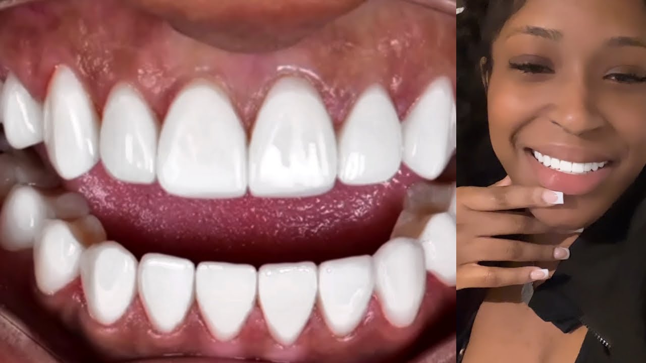 I got porcelain veneers in Cali Columbia with Dr. Toro
