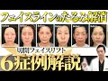 【保存版】フェイスラインのたるみ解消！切開フェイスリフト6症例をたるみ取りのプロが徹底解説！【切開リフト/糸リフト/リフトアップ】