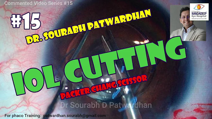 Commented 15 IOL cutting and exchange Dr Sourabh P...