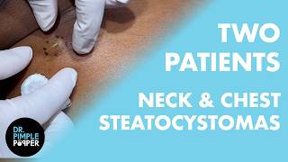What are These Neck & Chest Bumps? | Dr. Pimple Popper Helps Two Steatocystoma Patients