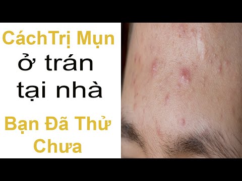 Cách Trị Mụn Ở Trán Tại Nhà Bạn Đã Thử Chưa - Mỹ Phẩm SOSENCO