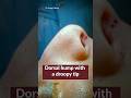Rhinoplasty Before &amp; After: Dorsal Hump Correction Surgery | #shorts #rhinoplasty #drparagtelang