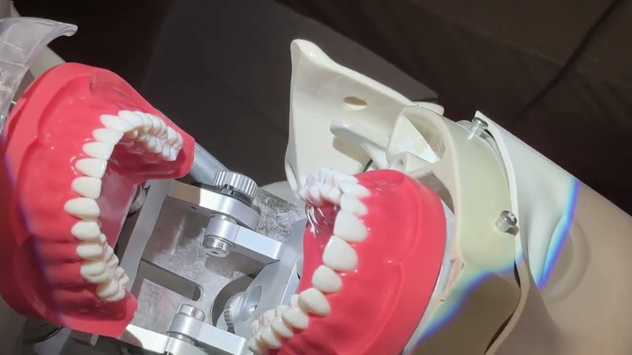 Фарфоровые виниры с лингвальной фаской №7 и №8 — д-р Марк Тейлор