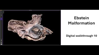 Digital specimen walkthrough 10- Ebstein malformation | Cardiac anatomy!