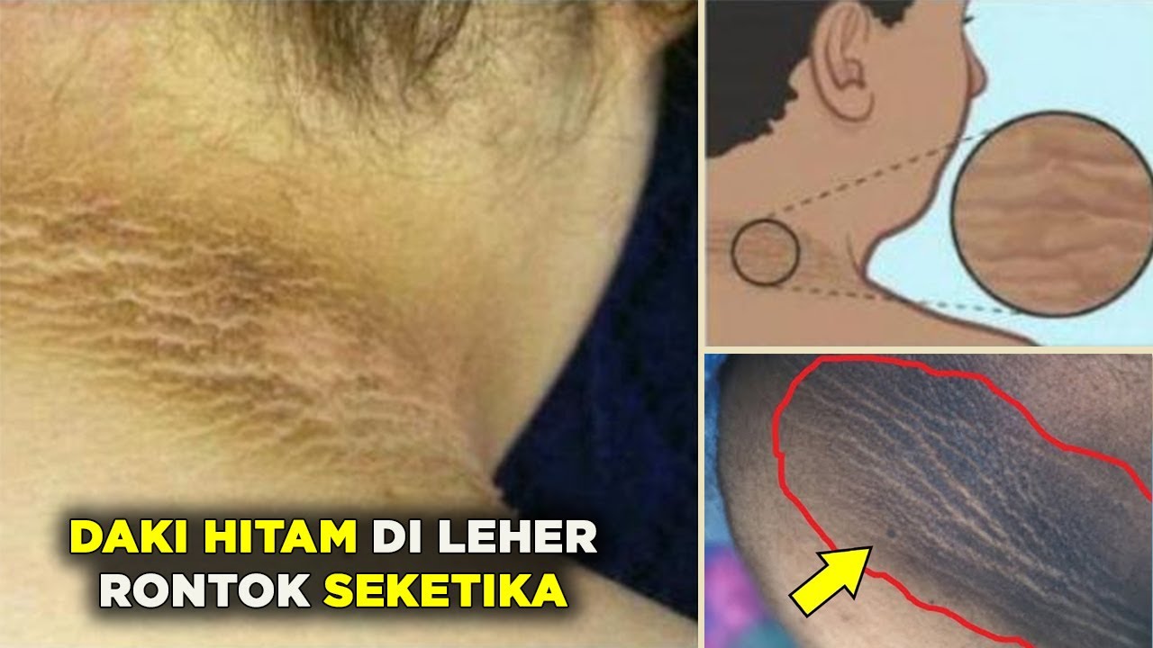 Cara Menghilangkan Daki Hitam Di Leher