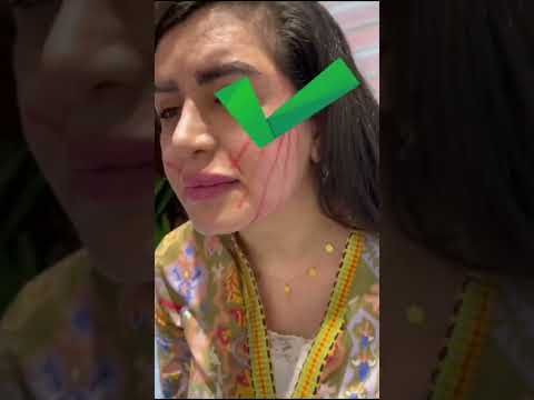عمليه شد الوجه بلخيوط ذهبيه شاهد تغير الكامل لشكل قبل وبعد تجميل