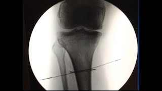 Tibia Perkutan Gigli Osteotomisi Tekniği (Video Sunumu)