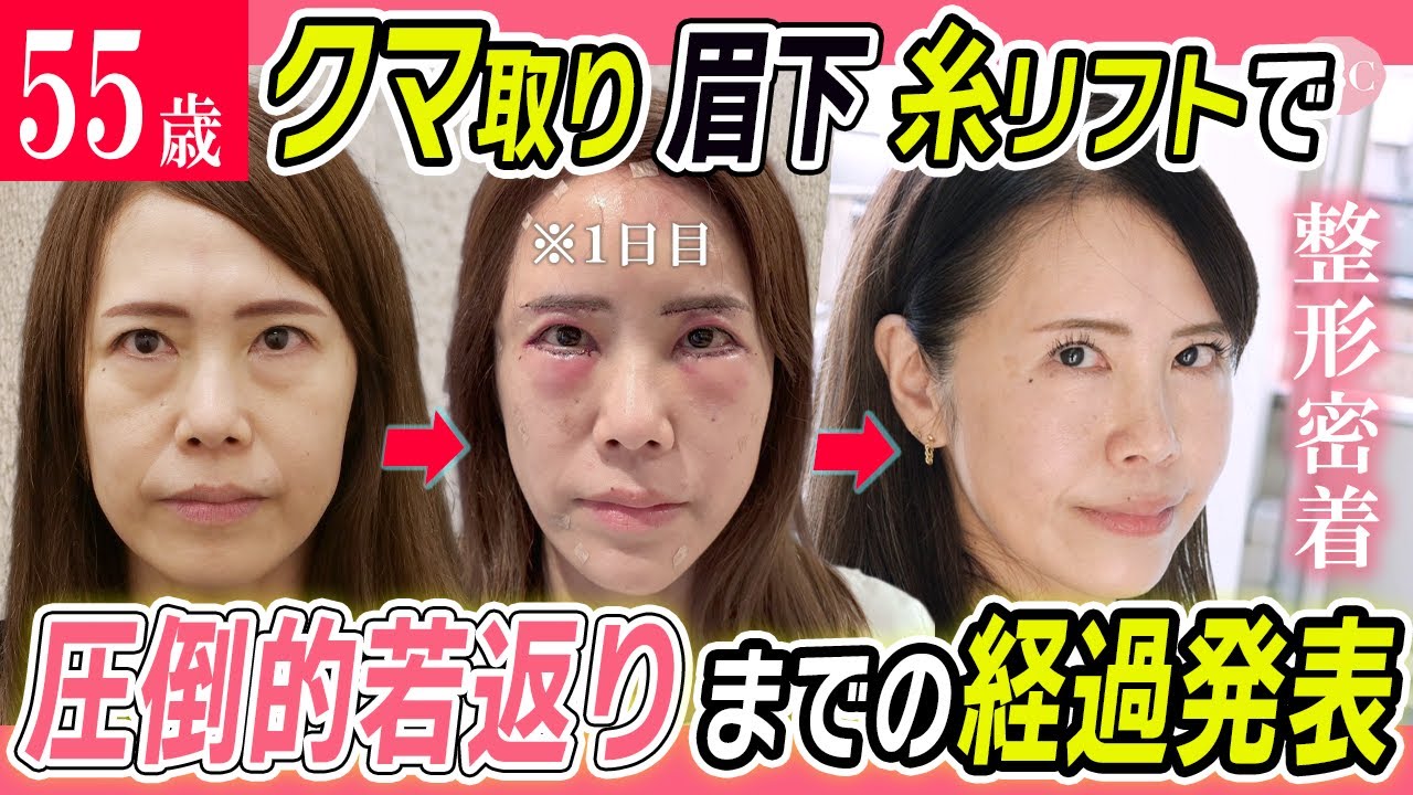 【50代の衝撃クマ取り】ハムラと眉下切開を同時にしたら劇的若返りだった【糸リフト】湘南美容クリニック
