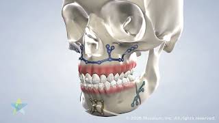Jaw Surgery in Dallas, TX