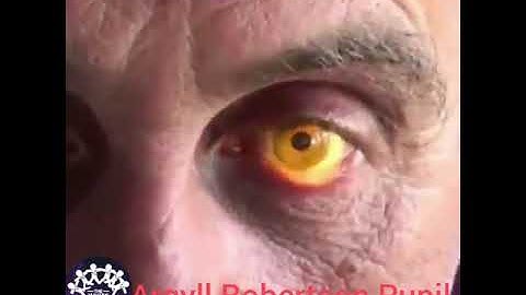 ARGYLL ROBERTSON PUPIL