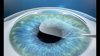 Benefits Of Smile In Comparision To Prk And Lasik