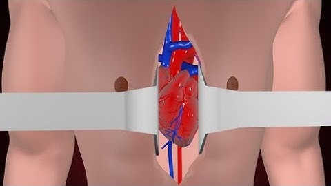 Open heart Bypass Surgery (3D Animation)