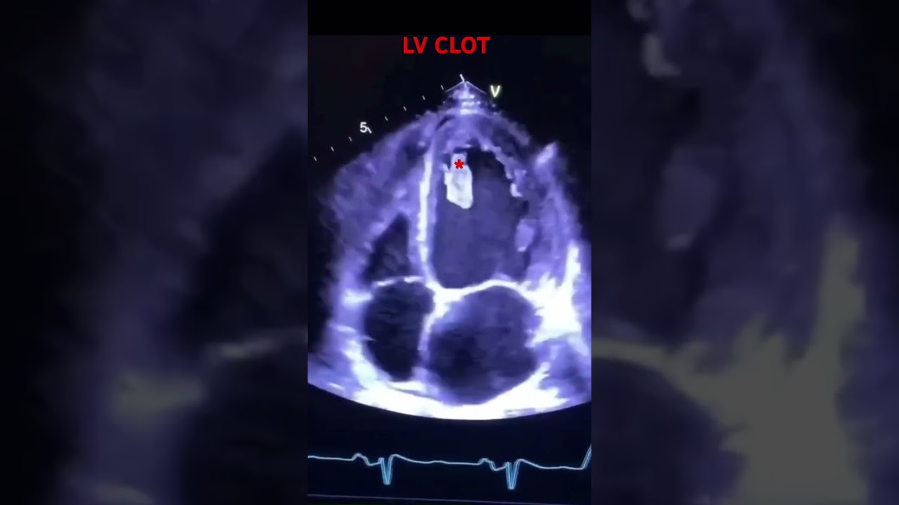 LV clot embolisation (credit - dr.fahad) 